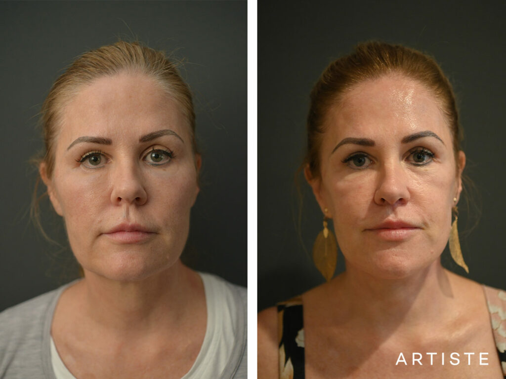 54 Years Old: High SMAS Face and Neck Lift Surgery, Micro Fat Grafting, Bull Horn Lip lift, 