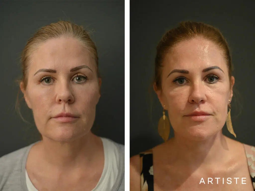 54 Years Old: High SMAS Face and Neck Lift, Micro Fat Grafting, Bull Horn Lip lift, 