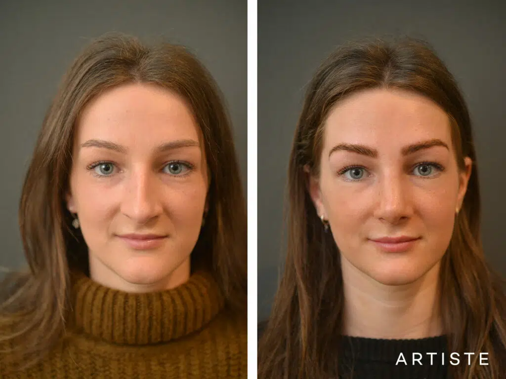 20 Years Old: 6 months Post Rhinoplasty