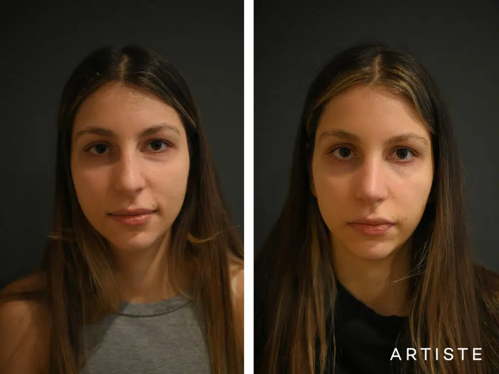 25 Years Old: 12 months Post Open Structure Rhinoplasty