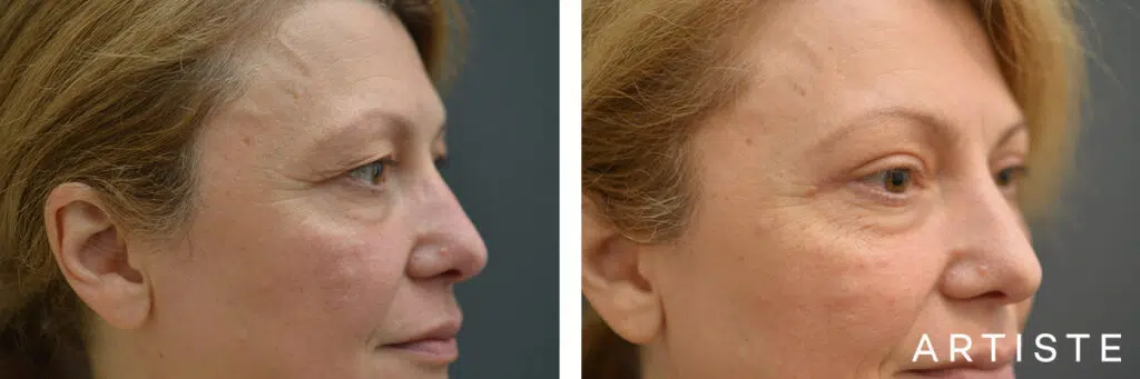 49 Years Old: Upper Eyelid Blepharoplasty