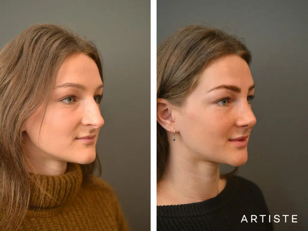 20 Years Old: 6 months Post Rhinoplasty