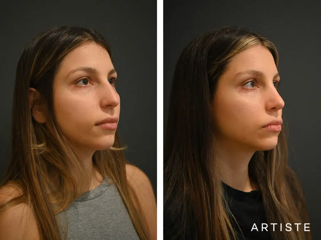 25 Years Old: 12 months Post Open Structure Rhinoplasty