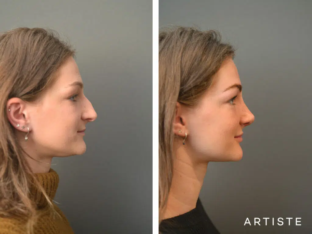 20 Years Old: 6 months Post Rhinoplasty