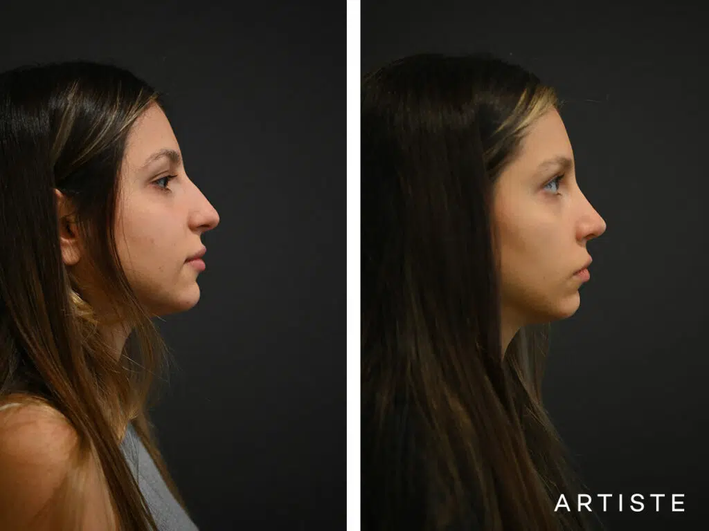 25 Years Old: 12 months Post Open Structure Rhinoplasty