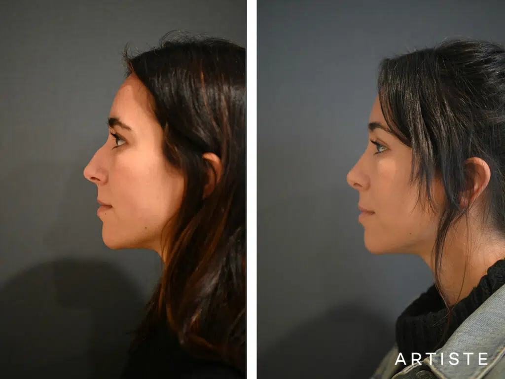 30 Years Old: 6 months Post Preservation Rhinoplasty