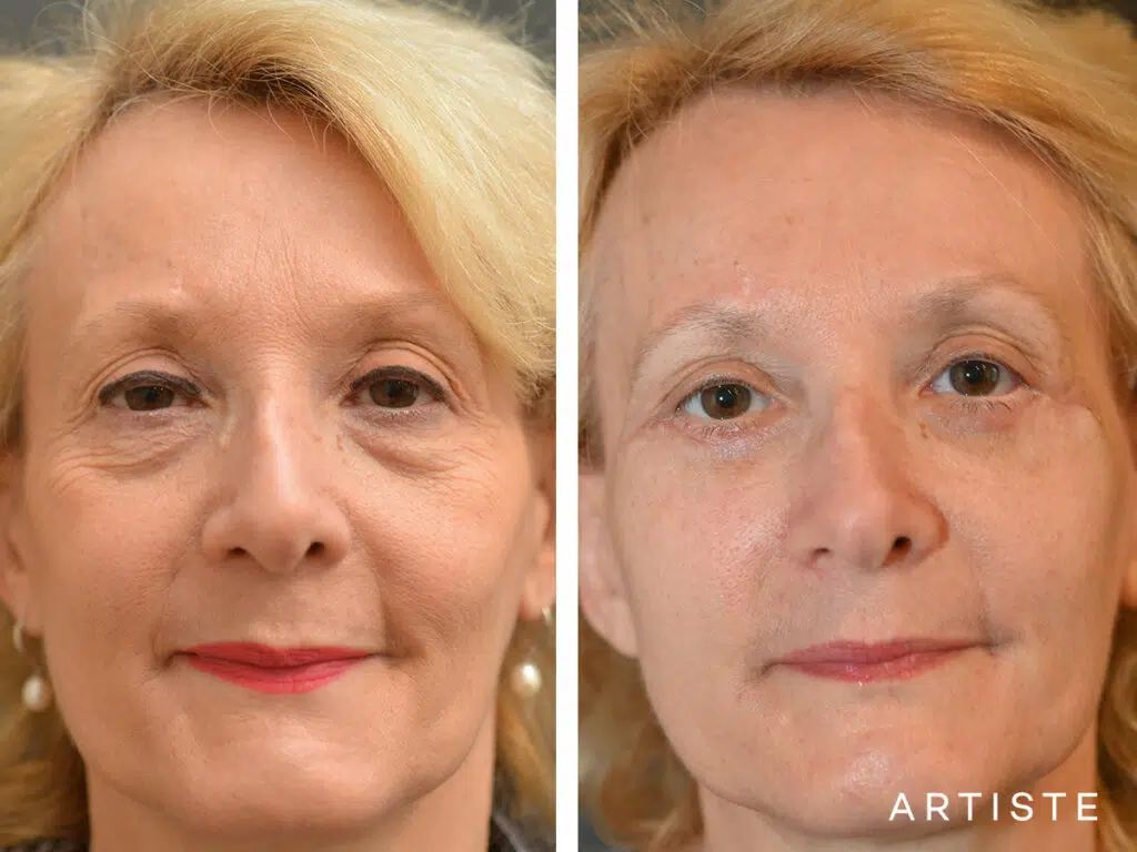 58 Years Old: Lower Eyelid Blepharoplasty