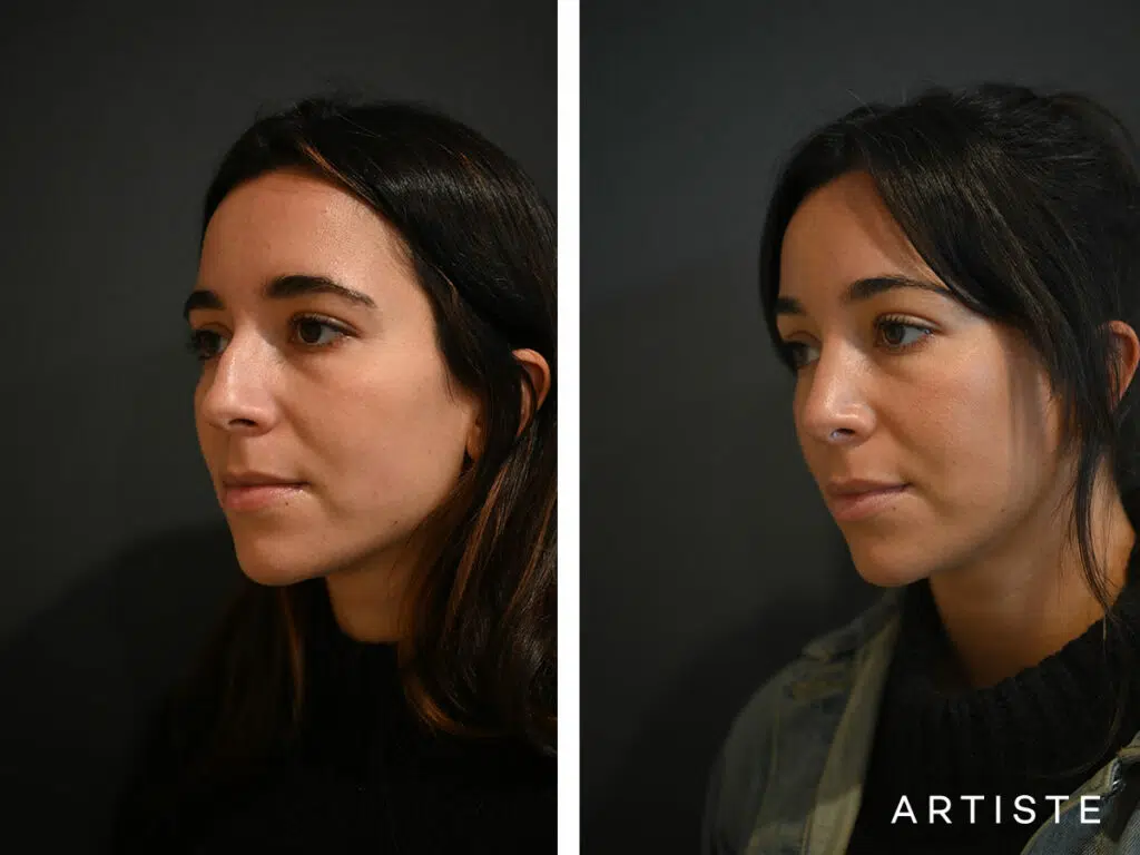 30 Years Old: 6 months Post Preservation Rhinoplasty