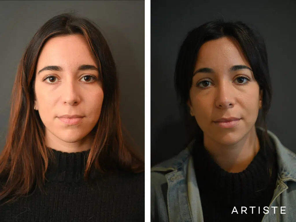 30 Years Old: 6 months Post Preservation Rhinoplasty