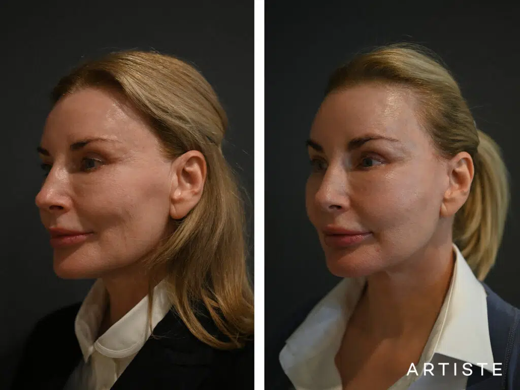 59 Years Old: Deep Plane Face and Neck Lift, Micro Fat Grafting, Peri-Oral Dermabrasion and Chemical Peel