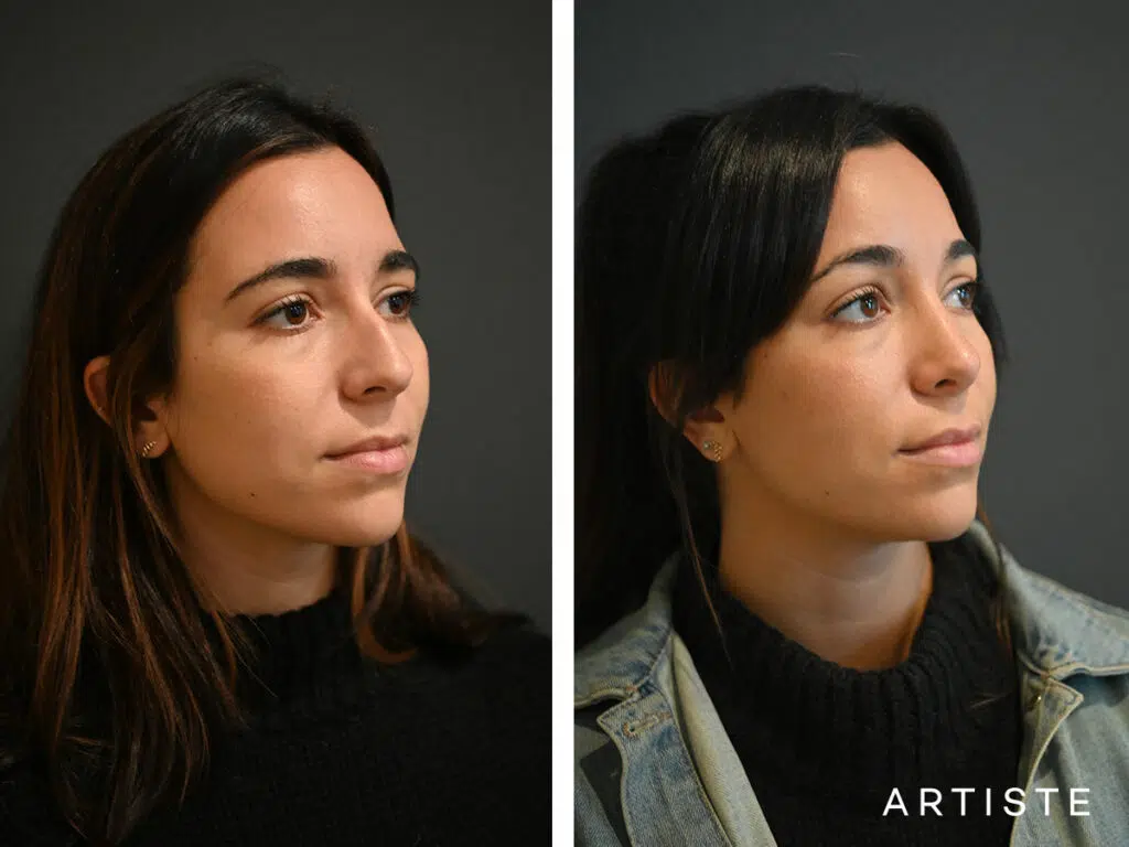 30 Years Old: 6 months Post Preservation Rhinoplasty