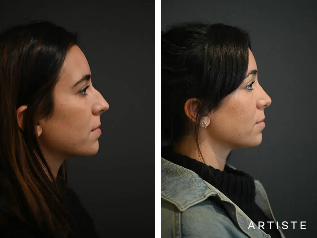 30 Years Old: 6 months Post Preservation Rhinoplasty