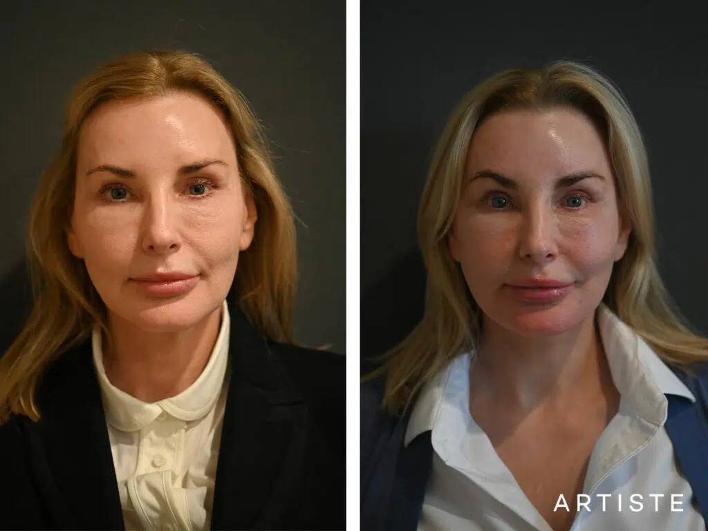 59 Years Old: Deep Plane Face and Neck Lift, Micro Fat Grafting, Peri-Oral Dermabrasion and Chemical Peel