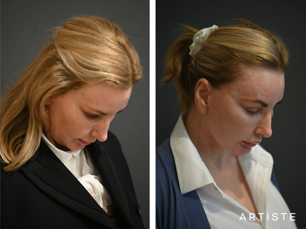59 Years Old: Deep Plane Face and Neck Lift Surgery, Micro Fat Grafting, Peri-Oral Dermabrasion and Chemical Peel