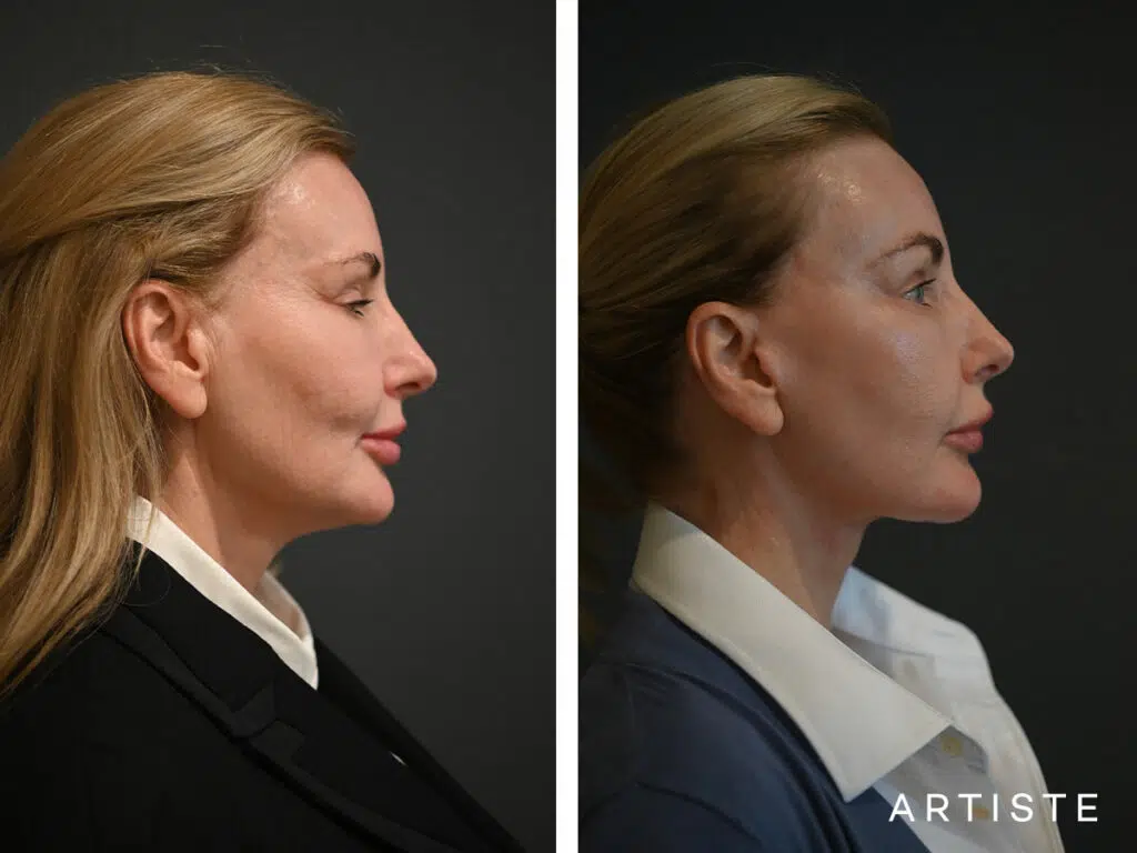 59 Years Old: Deep Plane Face and Neck Lift, Micro Fat Grafting, Peri-Oral Dermabrasion and Chemical Peel