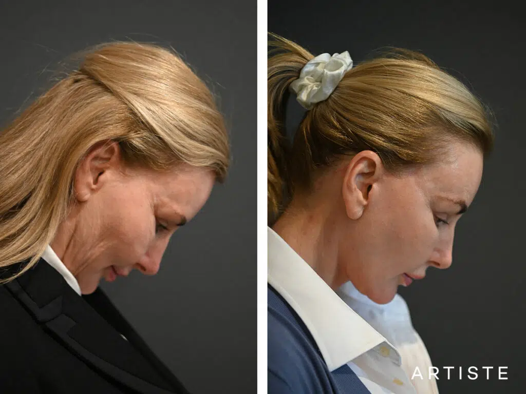 59 Years Old: Deep Plane Face and Neck Lift, Micro Fat Grafting, Peri-Oral Dermabrasion and Chemical Peel