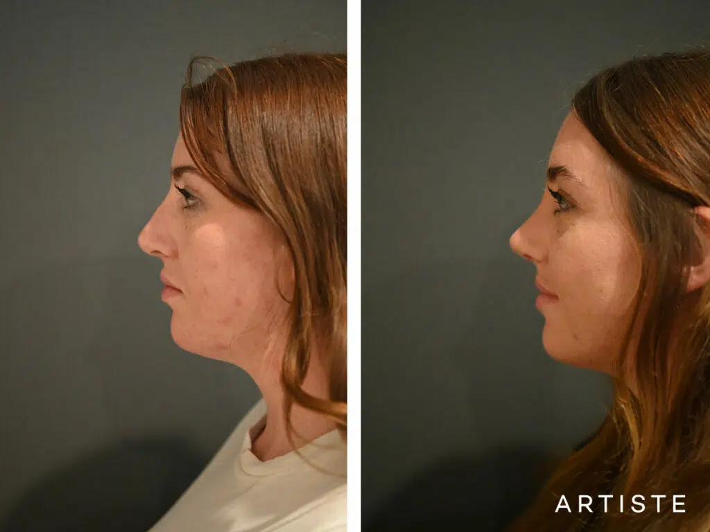 23 Years Old: Open Rhinoplasty