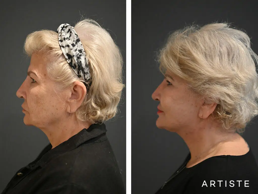 65 Years Old: High SMAS Face and Neck Lift, Micro Fat Grafting, Temporal Lift, Peri-Oral Dermabrasion and Chemical Peel