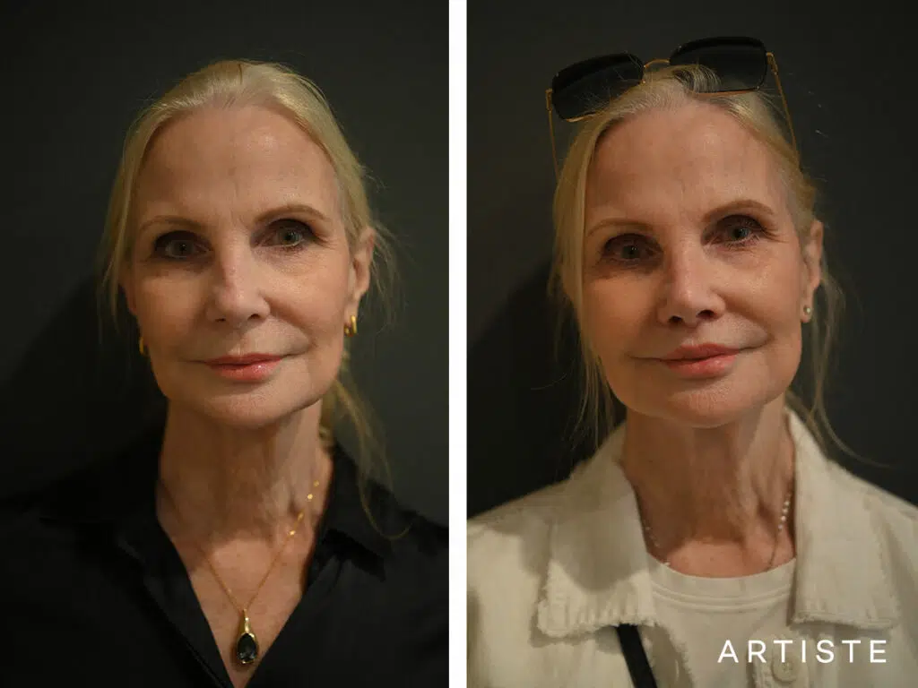 69 Years Old: 9 months Post Rhinoplasty