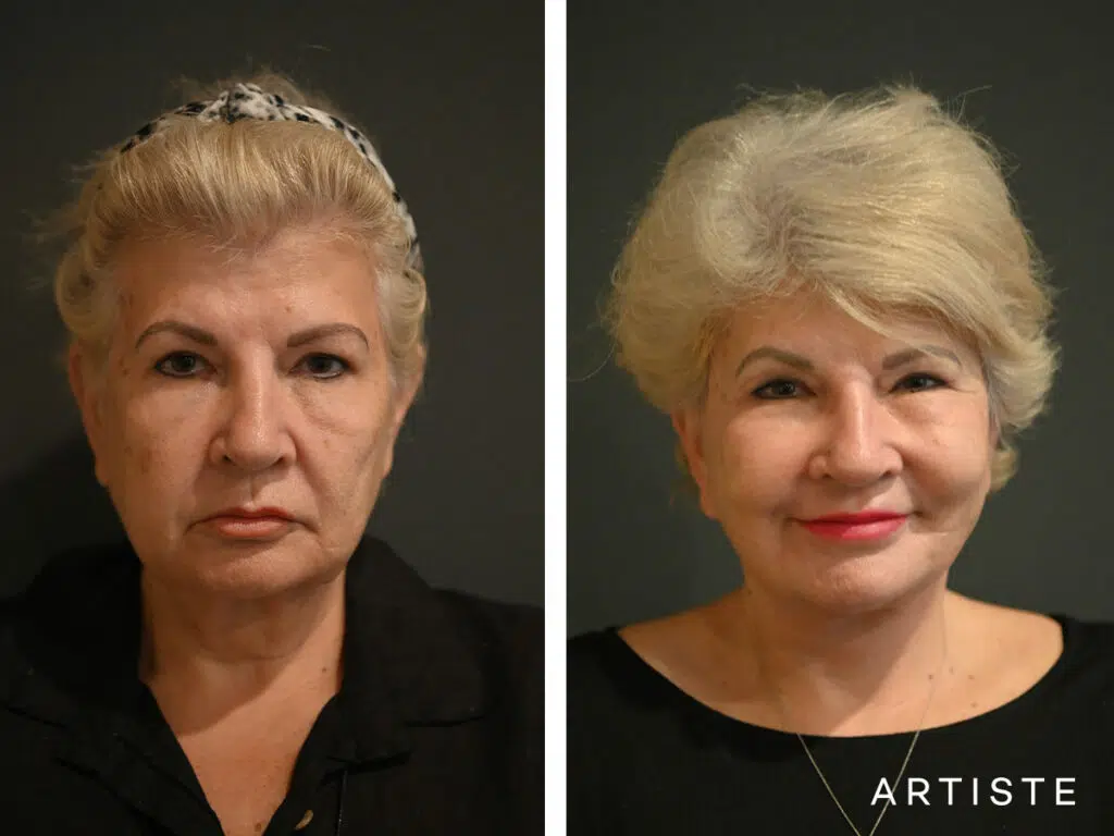 65 Years Old: High SMAS Face and Neck Lift, Micro Fat Grafting, Temporal Lift, Peri-Oral Dermabrasion and Chemical Peel