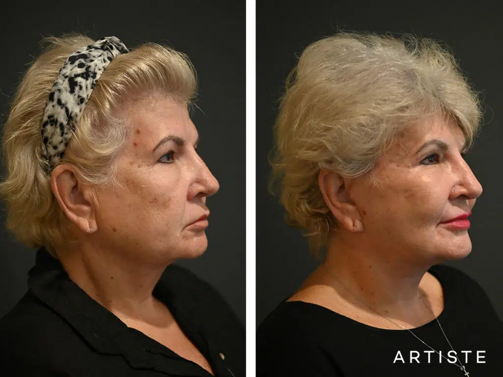 65 Years Old: High SMAS Face and Neck Lift, Micro Fat Grafting, Temporal Lift, Peri-Oral Dermabrasion and Chemical Peel