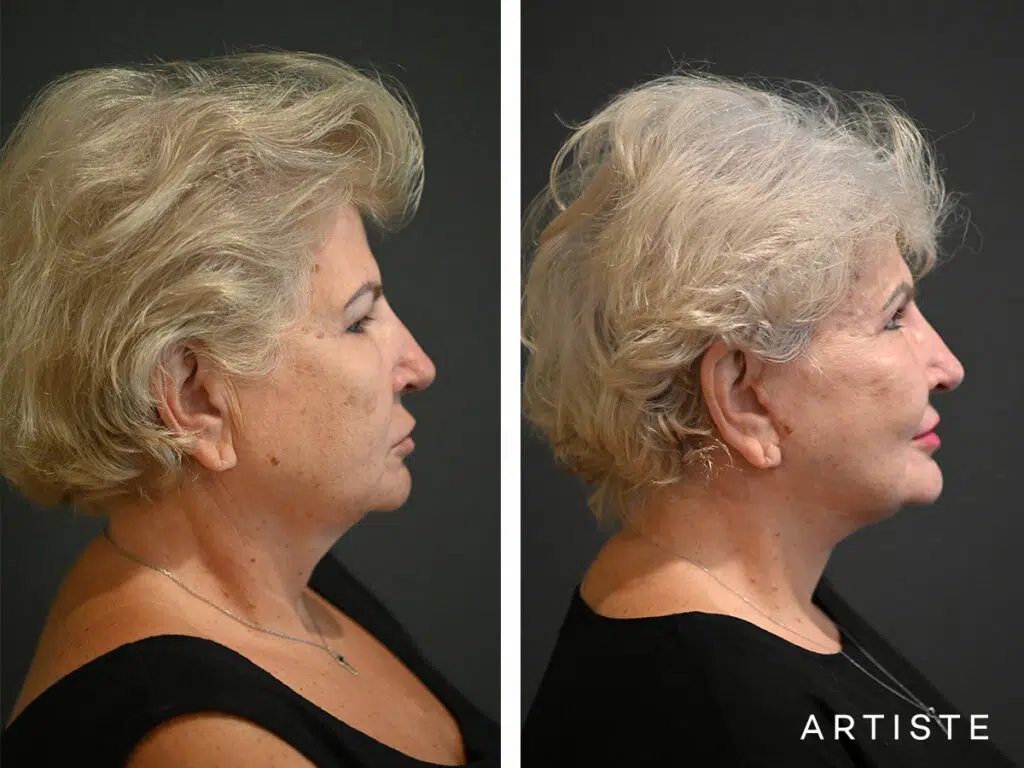 65 Years Old: High SMAS Face and Neck Lift, Micro Fat Grafting, Temporal Lift, Peri-Oral Dermabrasion and Chemical Peel