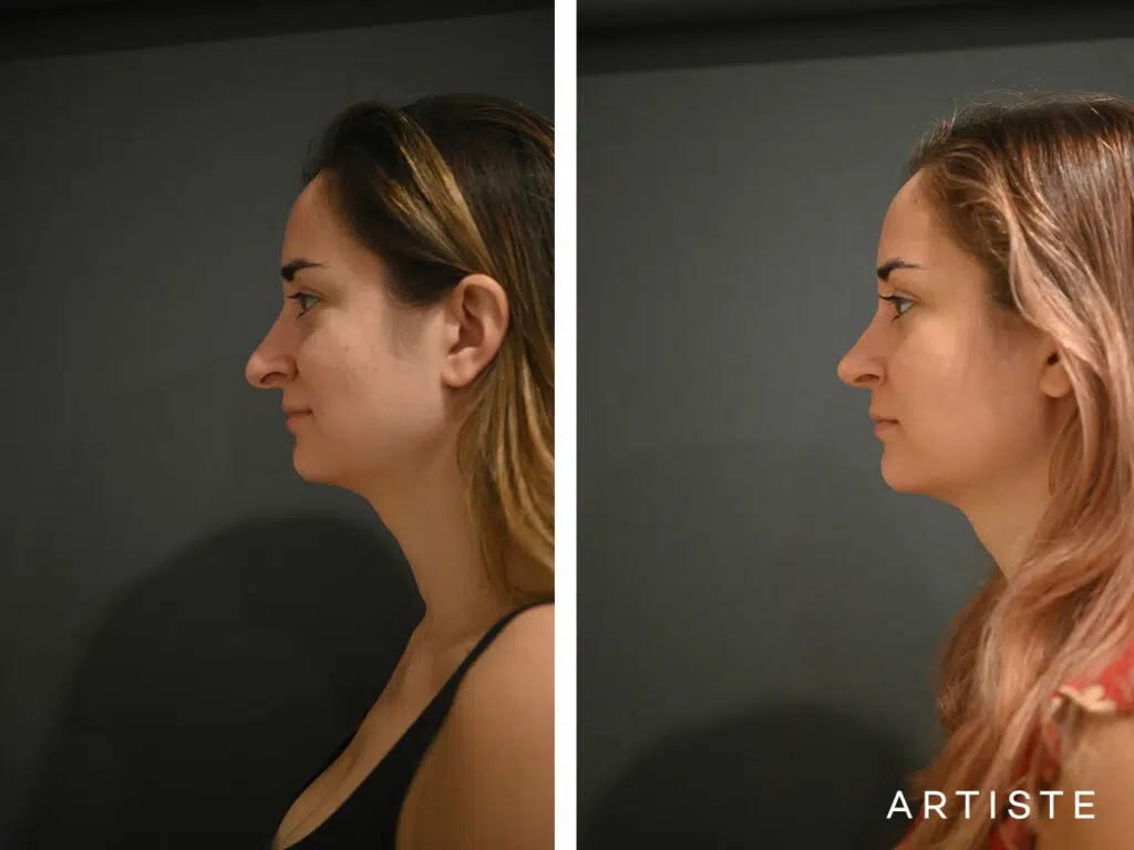 30 Years Old: Open Structure Rhinoplasty