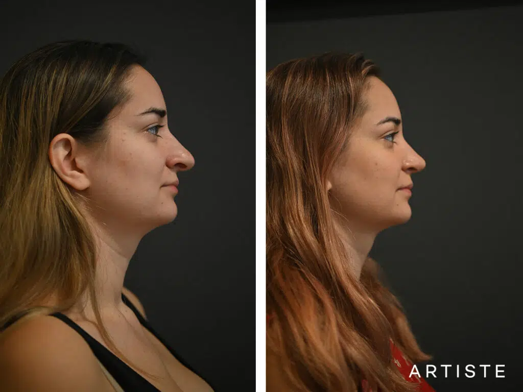 30 Years Old: Open Structure Rhinoplasty