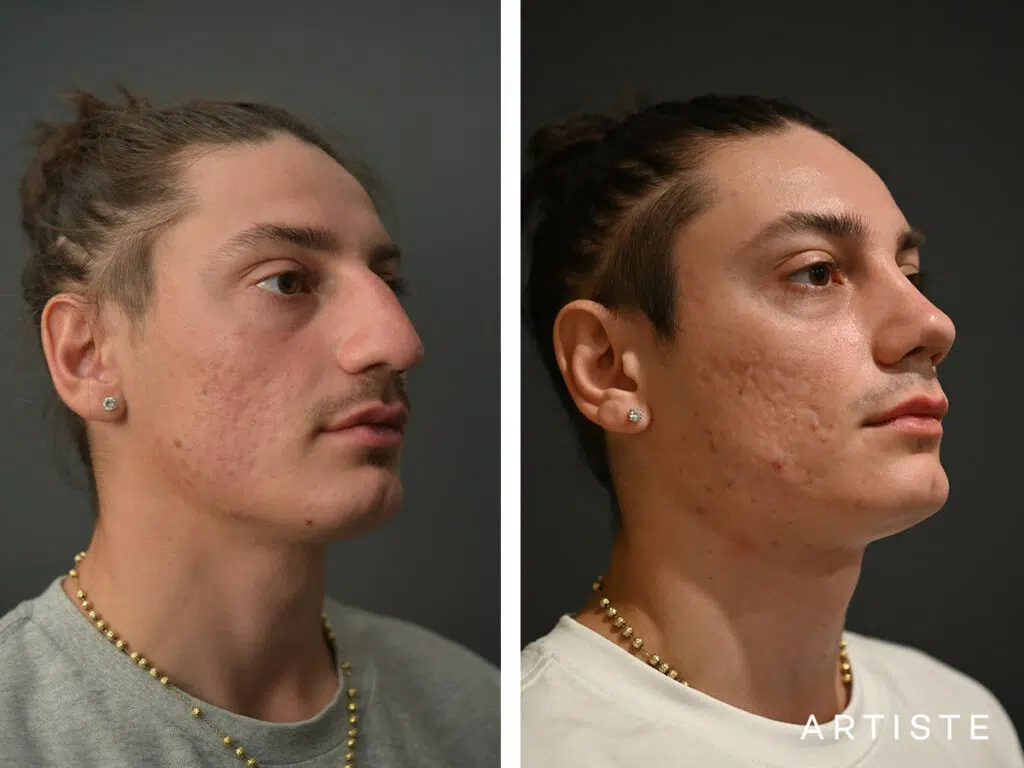 24 Years Old: Male Rhinoplasty