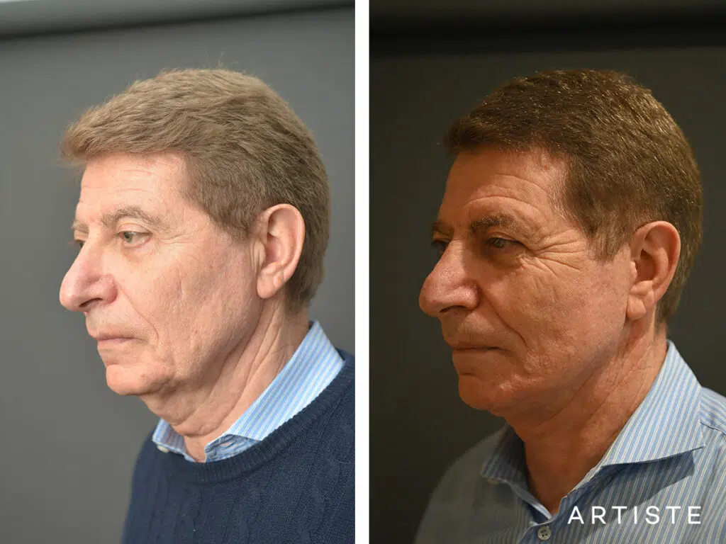 71 Years Old: Deep Plane Face and Neck Lift