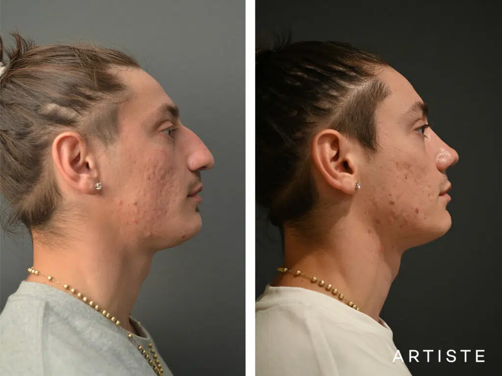 24 Years Old: Male Rhinoplasty