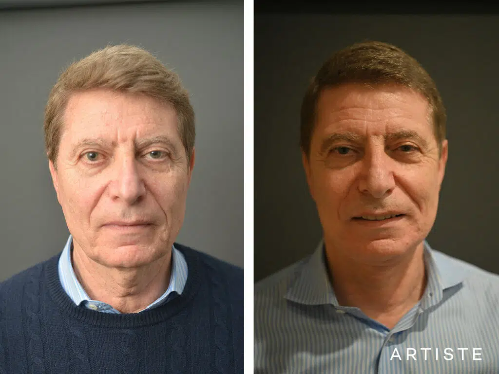 71 Years Old: Deep Plane Face and Neck Lift