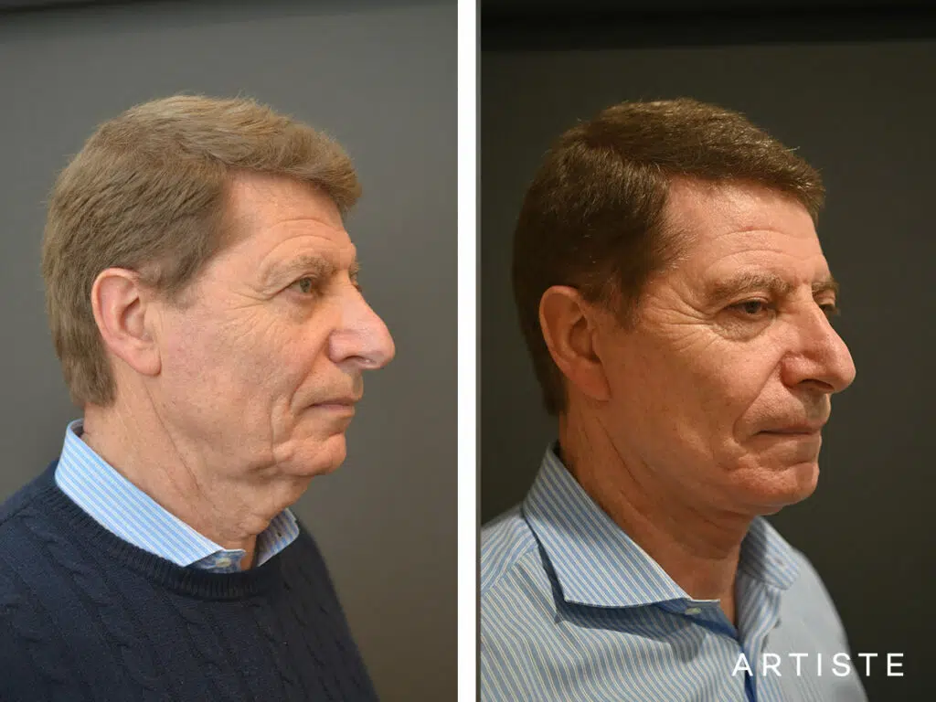 71 Years Old: Deep Plane Face and Neck Lift