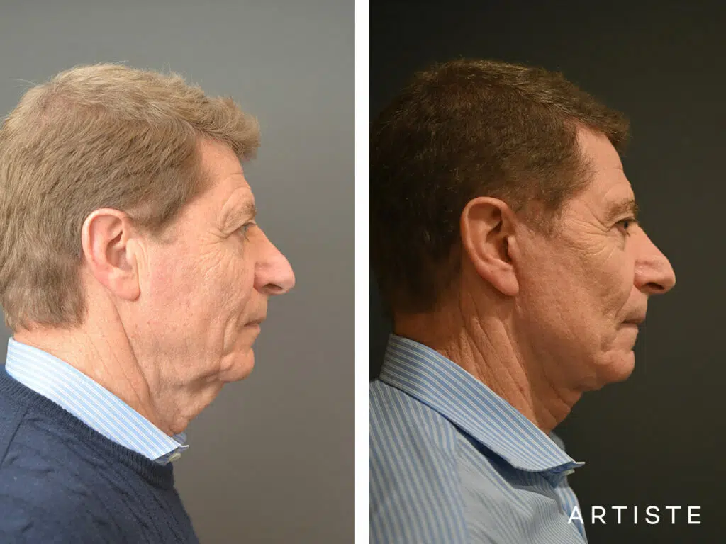 71 Years Old: Deep Plane Face and Neck Lift