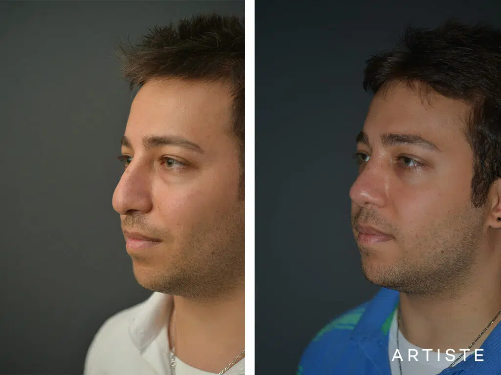 27 Years Old: Male Rhinoplasty