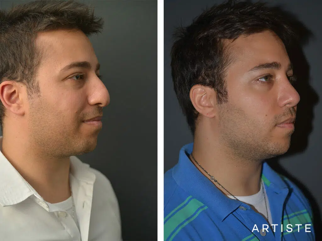 27 Years Old: Male Rhinoplasty