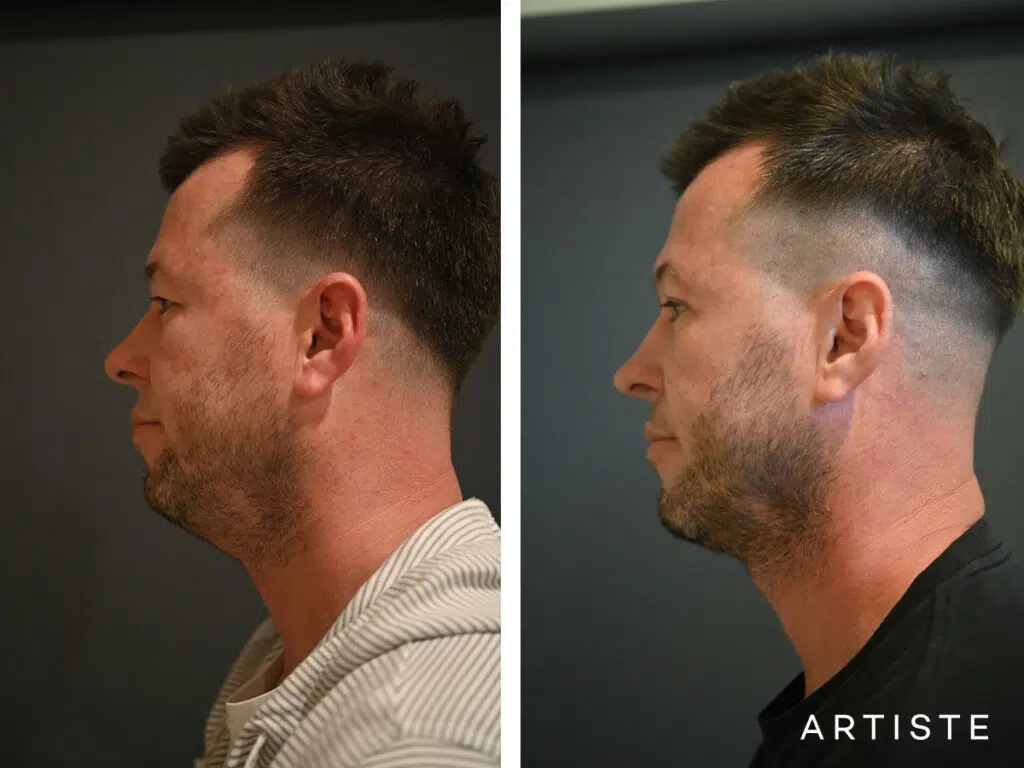 38 Years Old: Male Rhinoplasty and Upper Eyelid Blepharoplasty