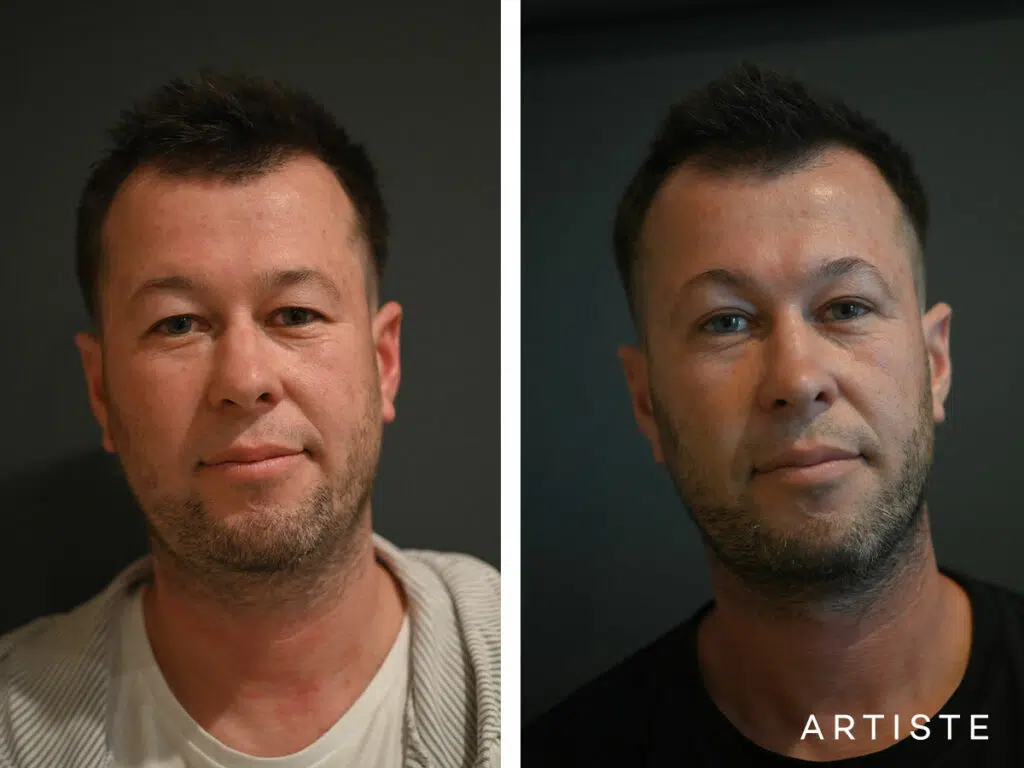 38 Years Old: Male Rhinoplasty and Upper Eyelid Blepharoplasty