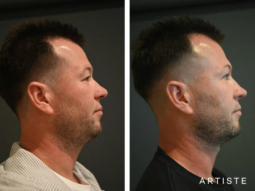 38 Years Old: Male Rhinoplasty and Upper Eyelid Blepharoplasty