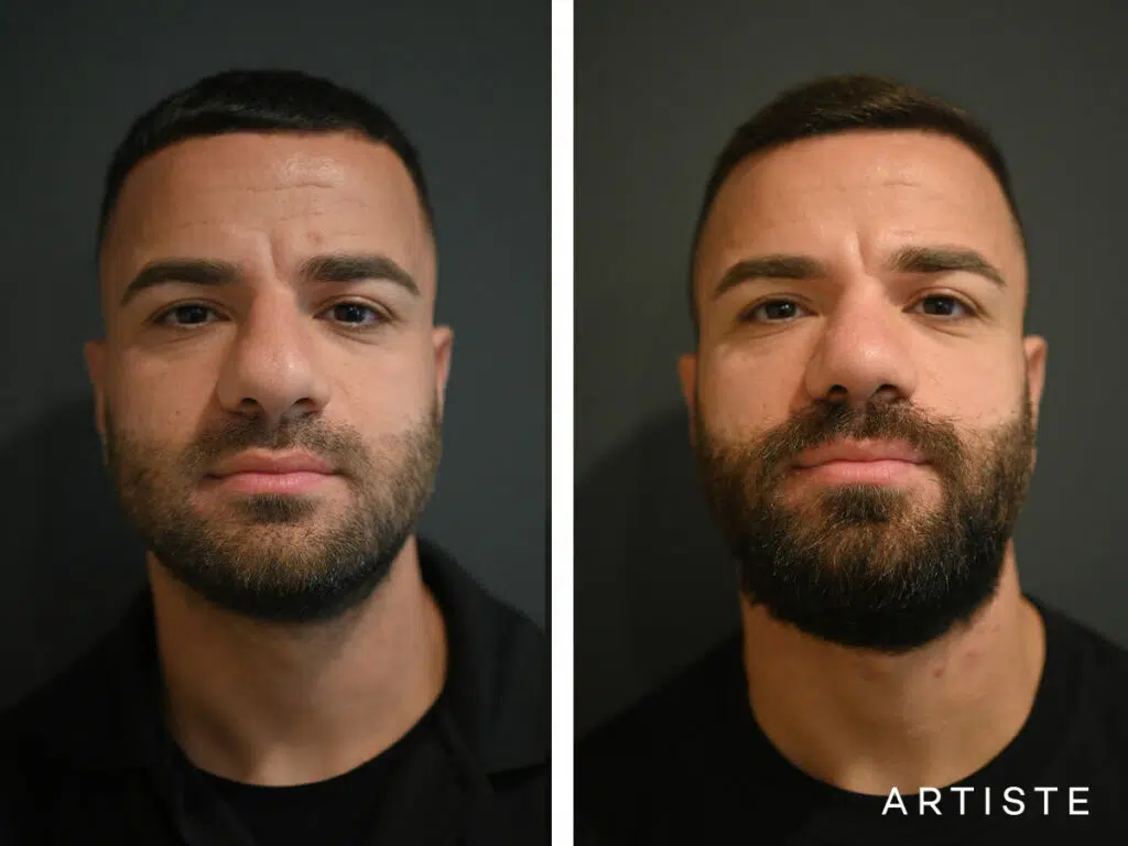 29 Years old: Male Rhinoplasty