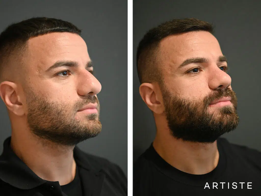 29 Years old: Male Rhinoplasty