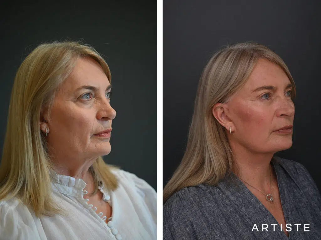 High SMAS Face and Neck Lift, Upper and Lower Eyelid Surgery, Fat transfer 12 months post