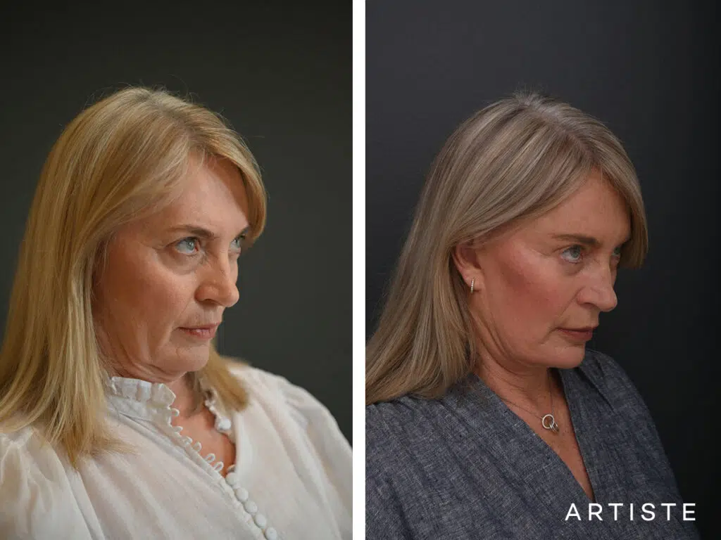 High SMAS Face and Neck Lift, Upper and Lower Eyelid Surgery, Fat transfer 12 months post