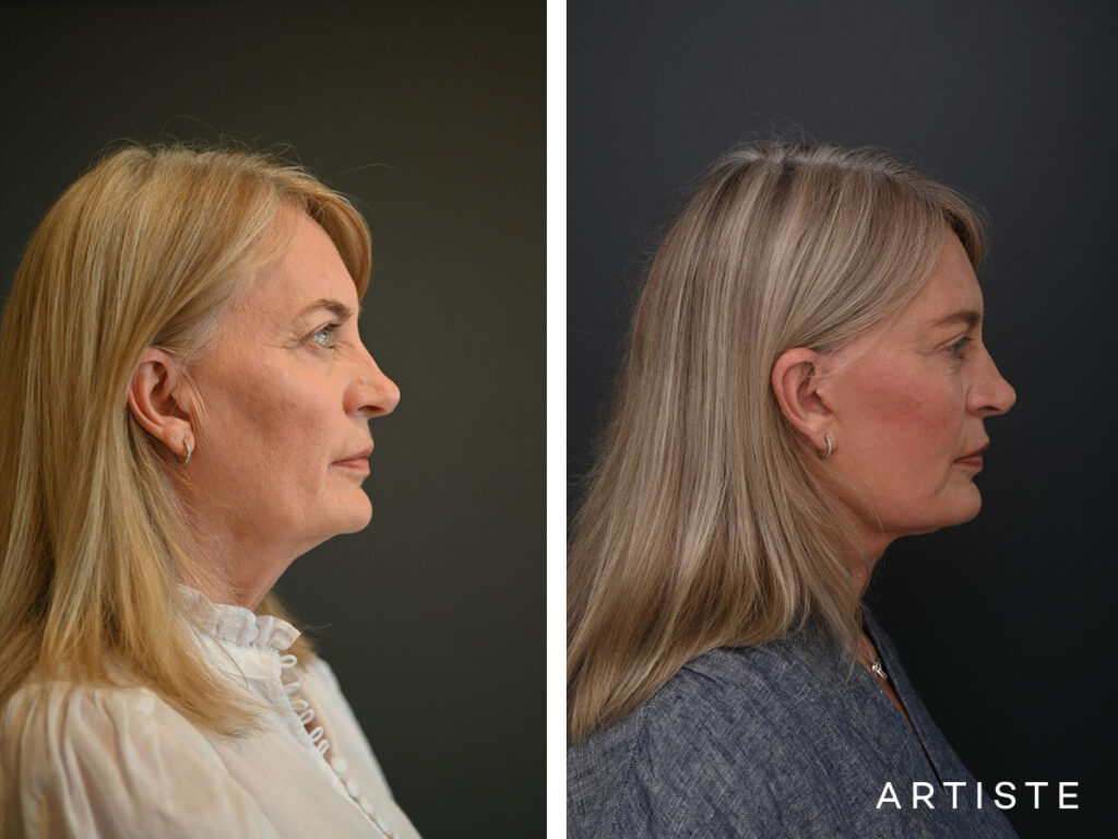 High SMAS Face and Neck Lift, Upper and Lower Eyelid Surgery, Fat transfer 12 months post