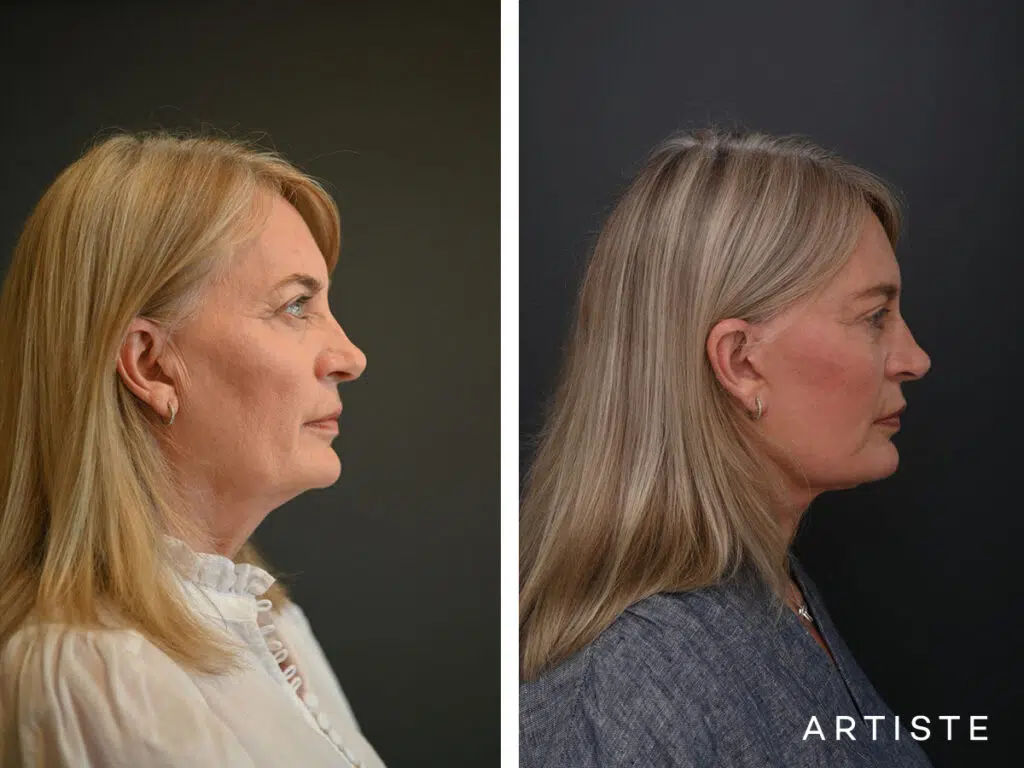 High SMAS Face and Neck Lift, Upper and Lower Eyelid Surgery, Fat transfer 12 months post