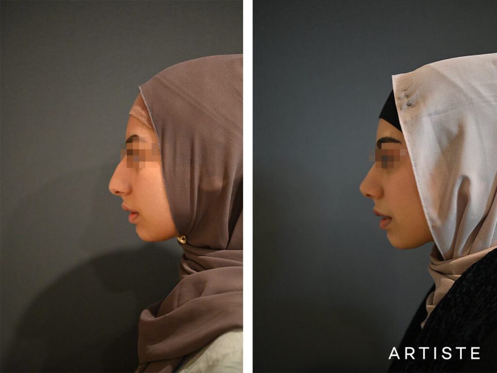 18 Years Old: Ethnic Open Rhinoplasty