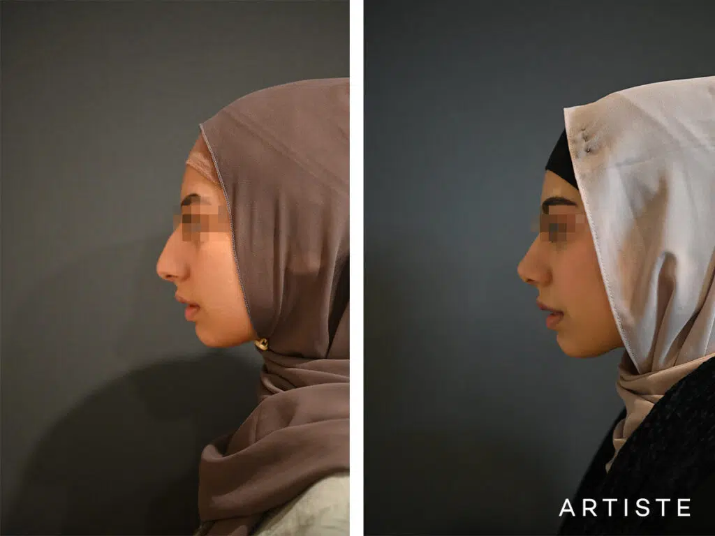 18 Years Old: Ethnic Open Rhinoplasty