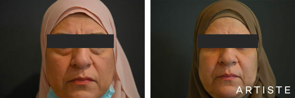 55 Years Old: Lower Eyelid Blepharoplasty