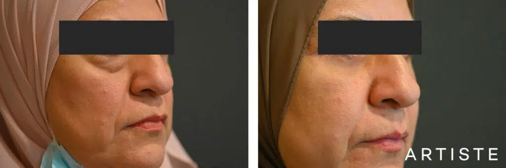 55 Years Old: Lower Eyelid Blepharoplasty