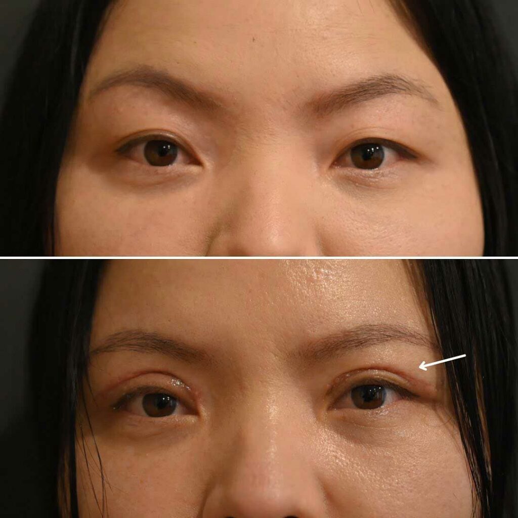 Double discount eyelid surgery